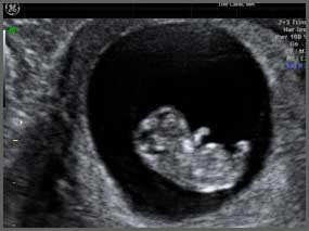 A black and white ultrasound of a baby in the womb.