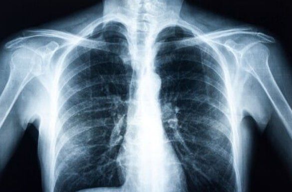 A chest x-ray — Jersey City, NJ — Pain and Disability Institute