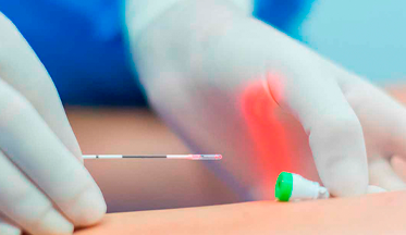 Láser endovenoso para eliminar várices. Instituto Médico Langle