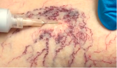 Tratamiento Venofoam. Instituto Médico Langle