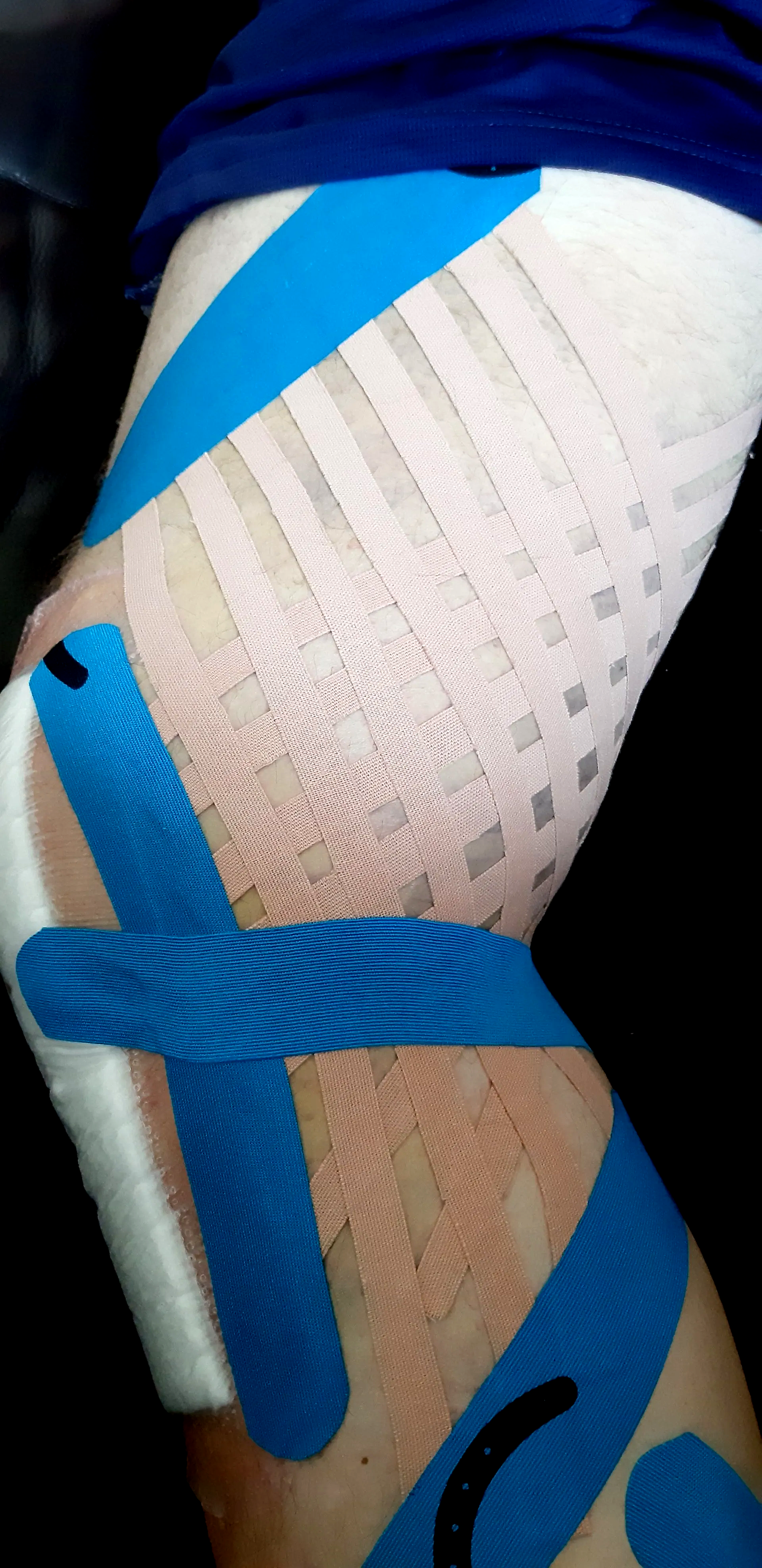 Knie operatie lymfetape blauwe plek