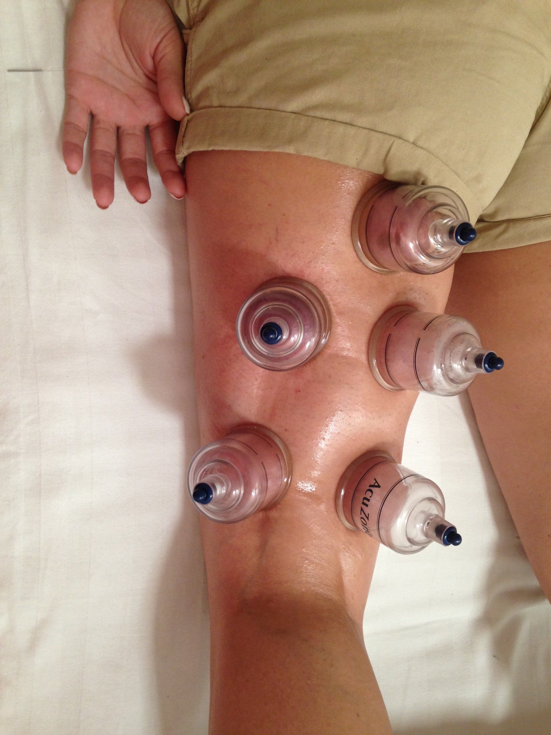 cupping massage therapeutisch cups