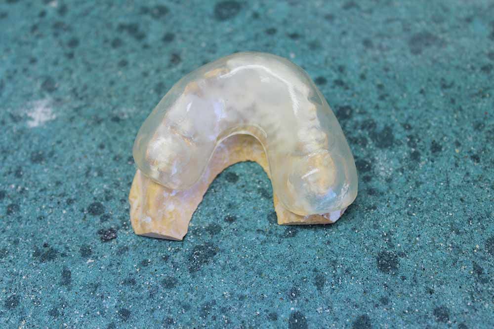 Partial Denture Mould— Dentures in Toukley, NSW