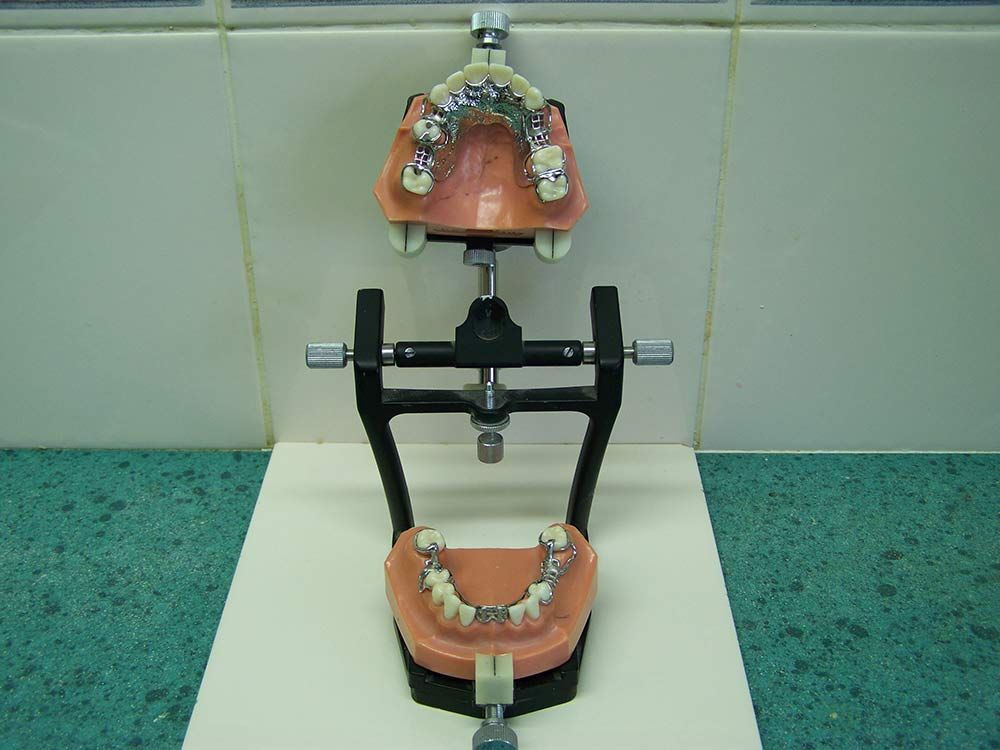 Dental Bridge Mould — Dentures in Toukley, NSW