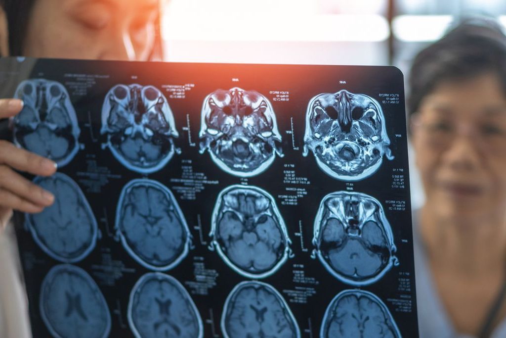 A doctor is holding a x-ray of a person 's brain.