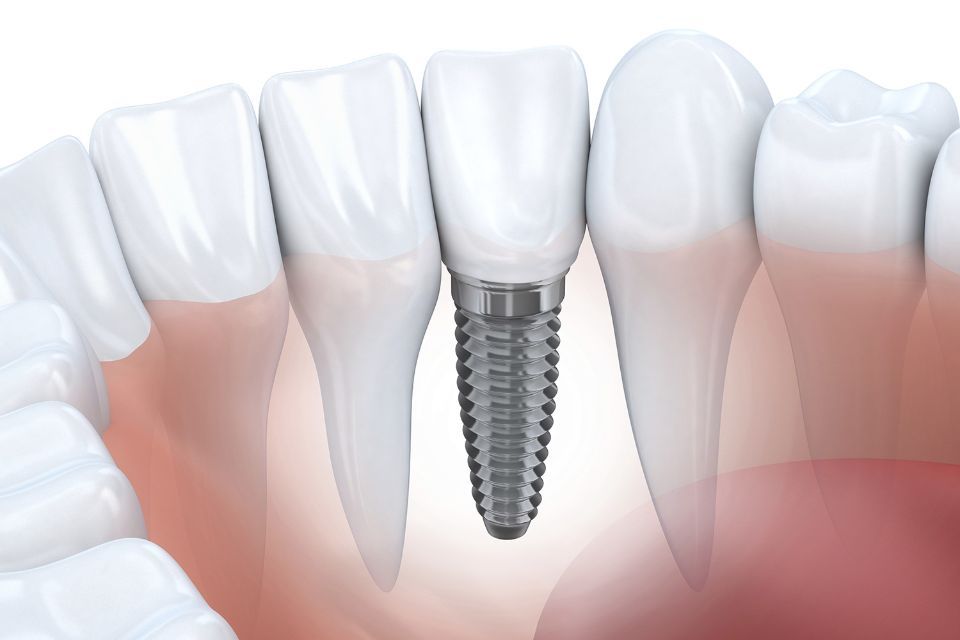 Rappresentazione di un impianto dentale