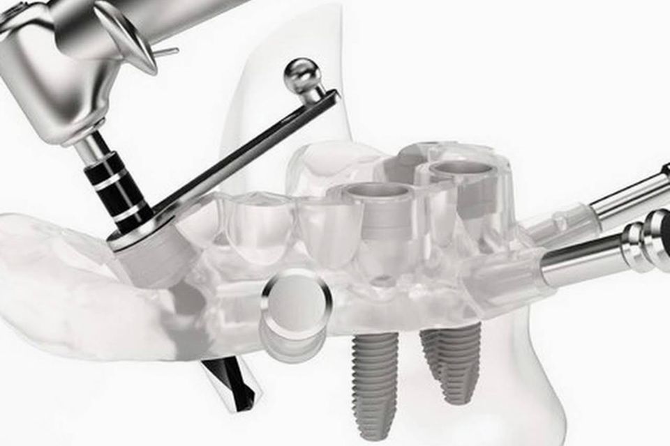 Rappresentazione di un intervento di implantologia dentale