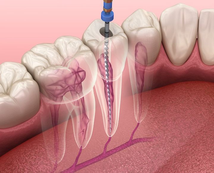 Rappresentazione di un trattamento endodontico