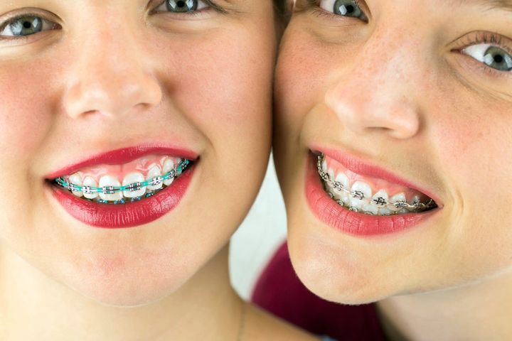 Apparecchi dentali fissi per bambini e adulti