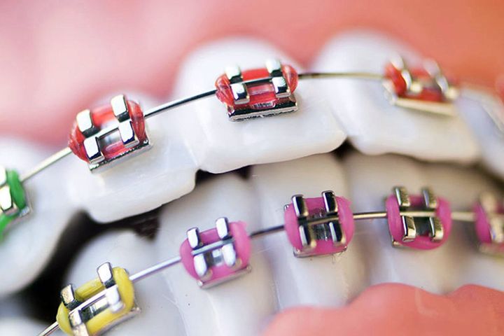 ortodonzia tradizionale