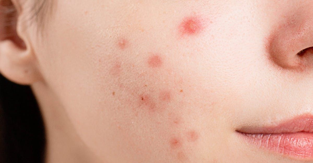 A close up of a woman 's face with acne on it.