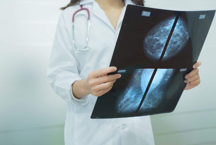 A healthcare professional in a white coat holding up mammogram X-ray films.