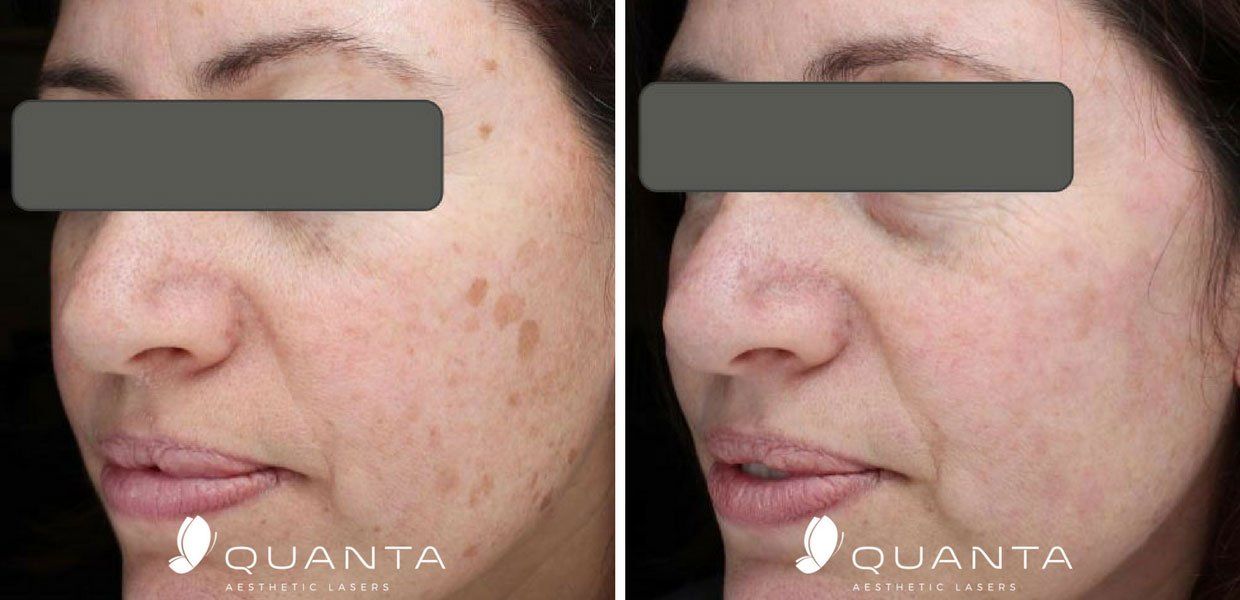 Rosacea Treatments Before and After Pictures At Maryland