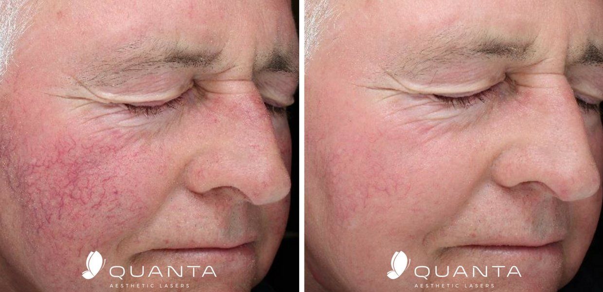 Rosacea Treatments Before and After Pictures At Maryland