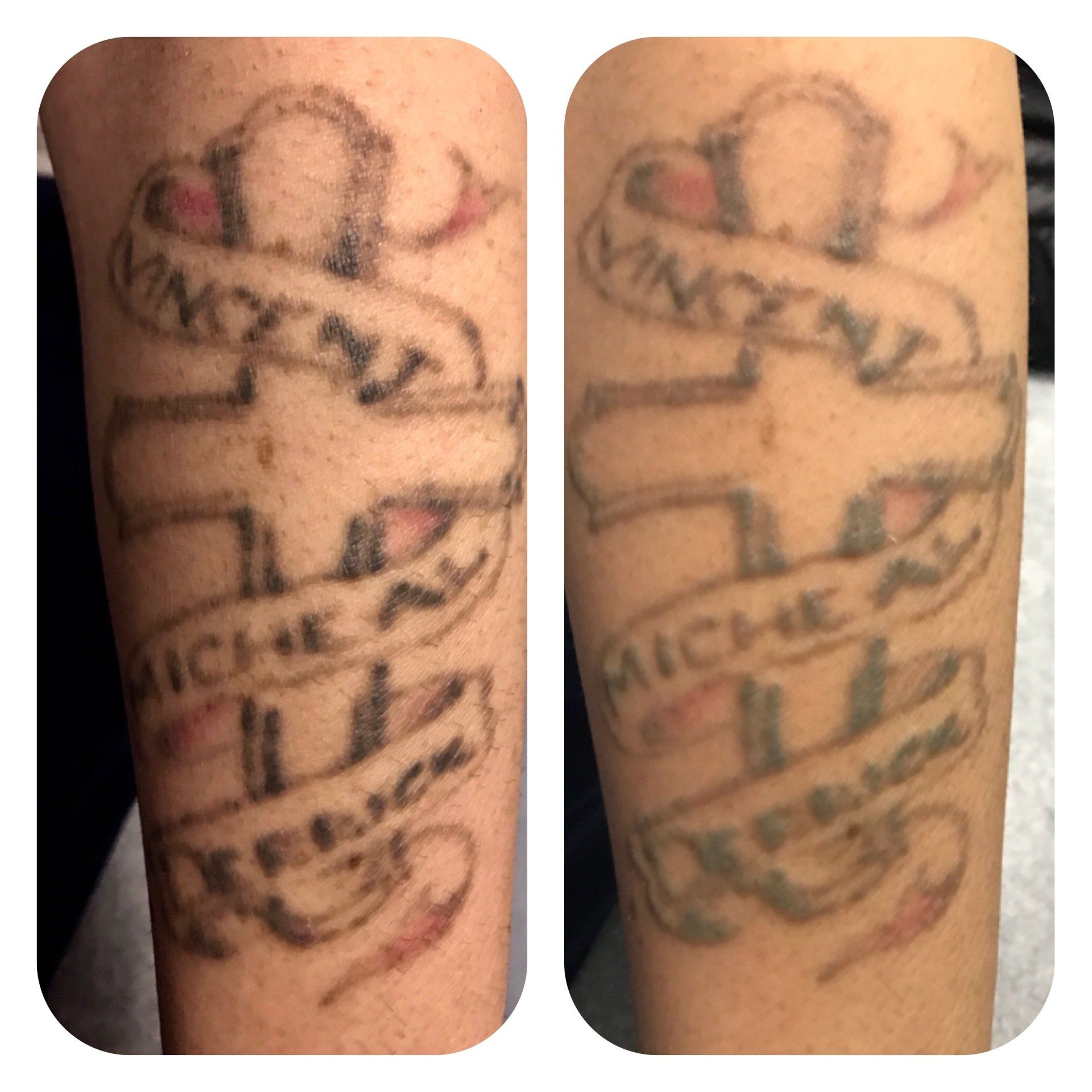 Laser Tattoo Removal In Maryland