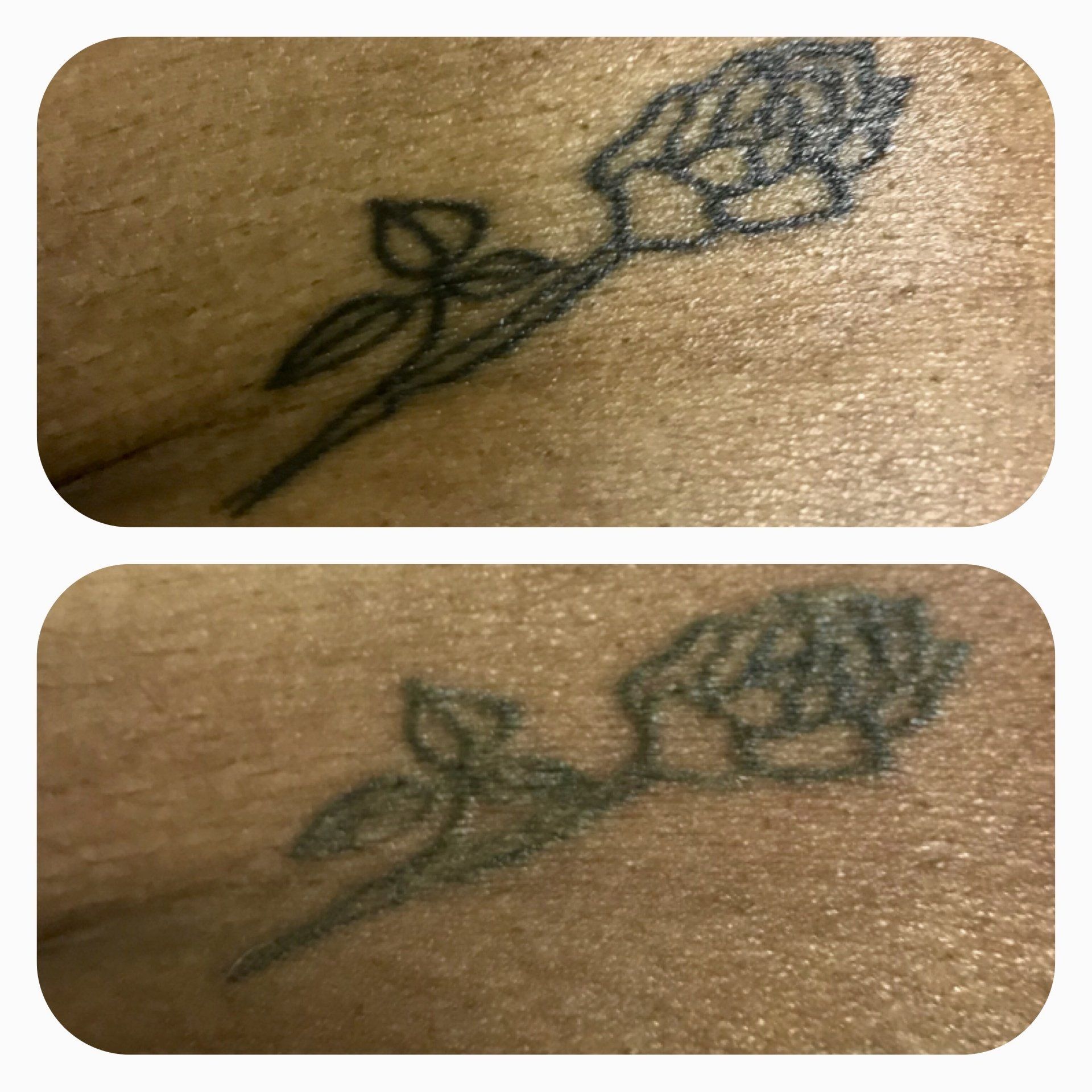 Laser Tattoo Removal In Maryland