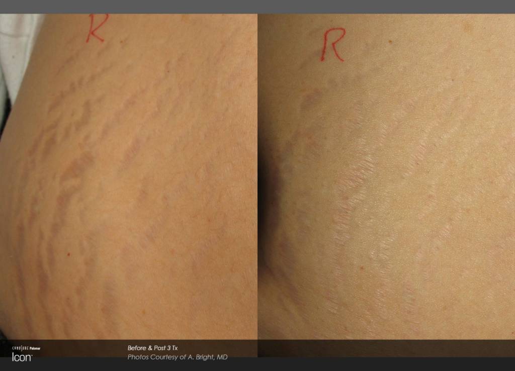 Stretch Mark Removal in Baltimore, MD