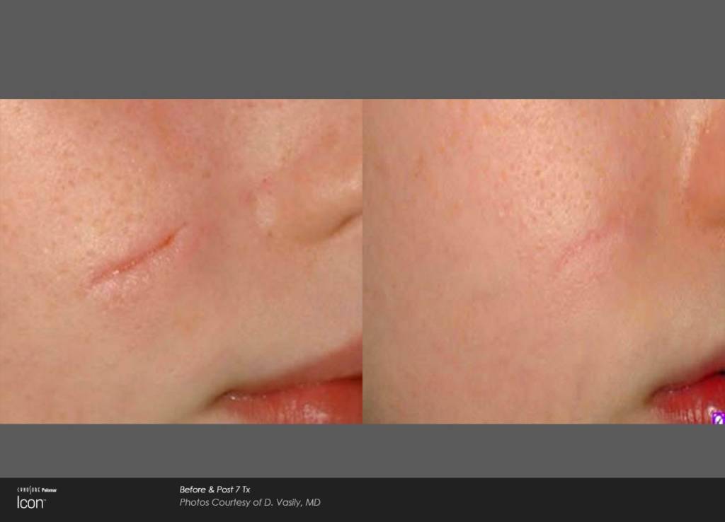 Stretch Mark Removal in Baltimore, MD