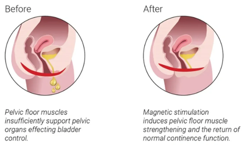 Intimawave Pelvic Treatment