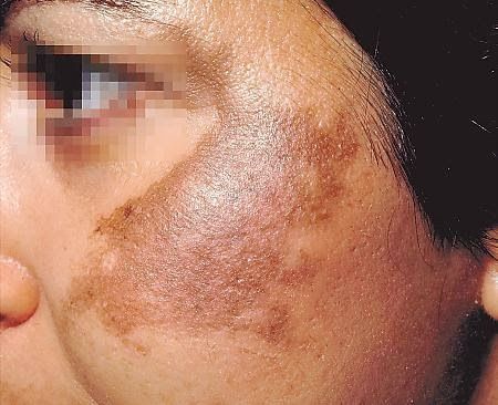 Melasma Treatment at Women's Health Services of Maryland