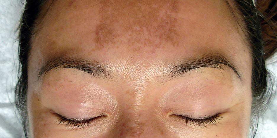 Melasma Treatment at Women's Health Services of Maryland