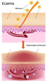 Allergy— Eczema Chart in Las Vegas, NV