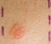 Eczema — Eczema Treatment in Las Vegas, NV