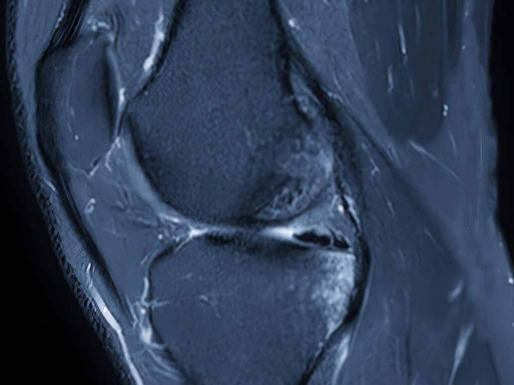MRI scan of knee joint Parkstone Osteopaths