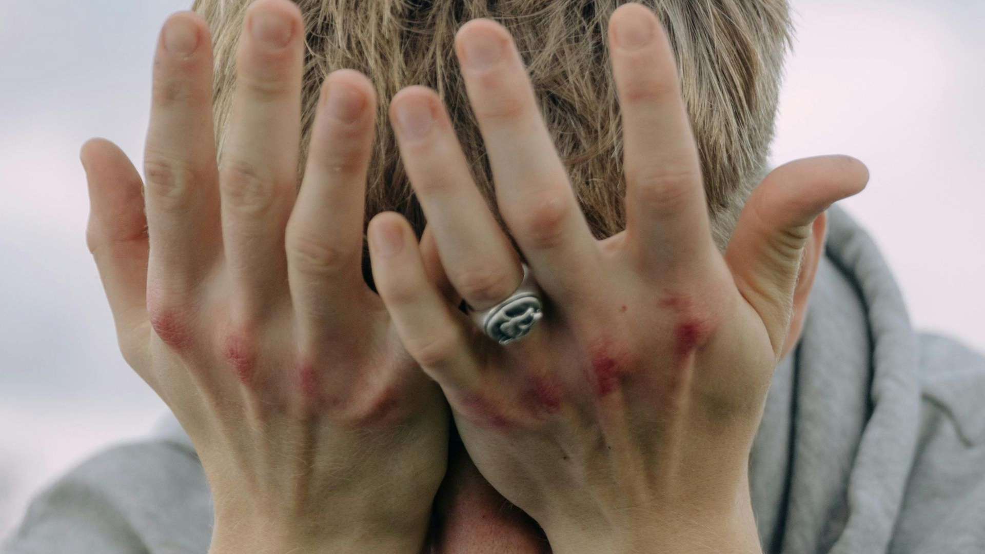 Person with hands covering face; bloodied knuckles. Focus on hands and wedding ring.