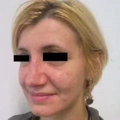 intervento piramide nasale dopo