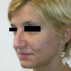 intervento piramide nasale prima