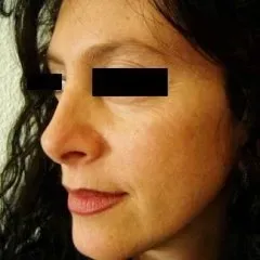 intervento piramide nasale dopo