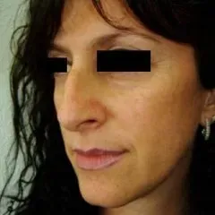 intervento piramide nasale prima