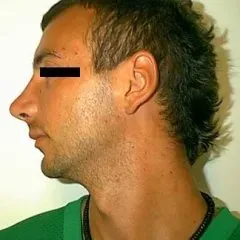 intervento piramide nasale dopo