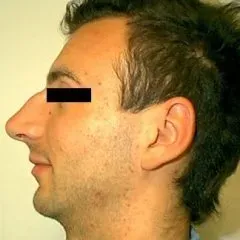 intervento piramide nasale prima