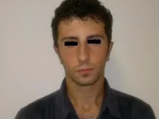 intervento padiglioni auricolari dopo