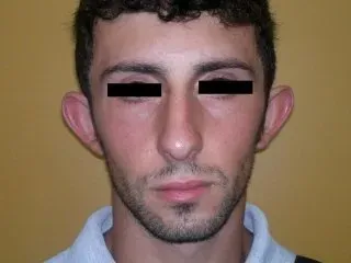 intervento padiglioni auricolari prima