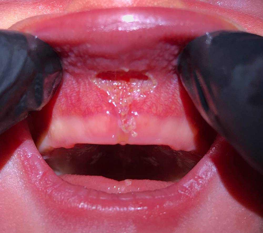 After Lip Tie Release | Children's Dentist in Hammond LA