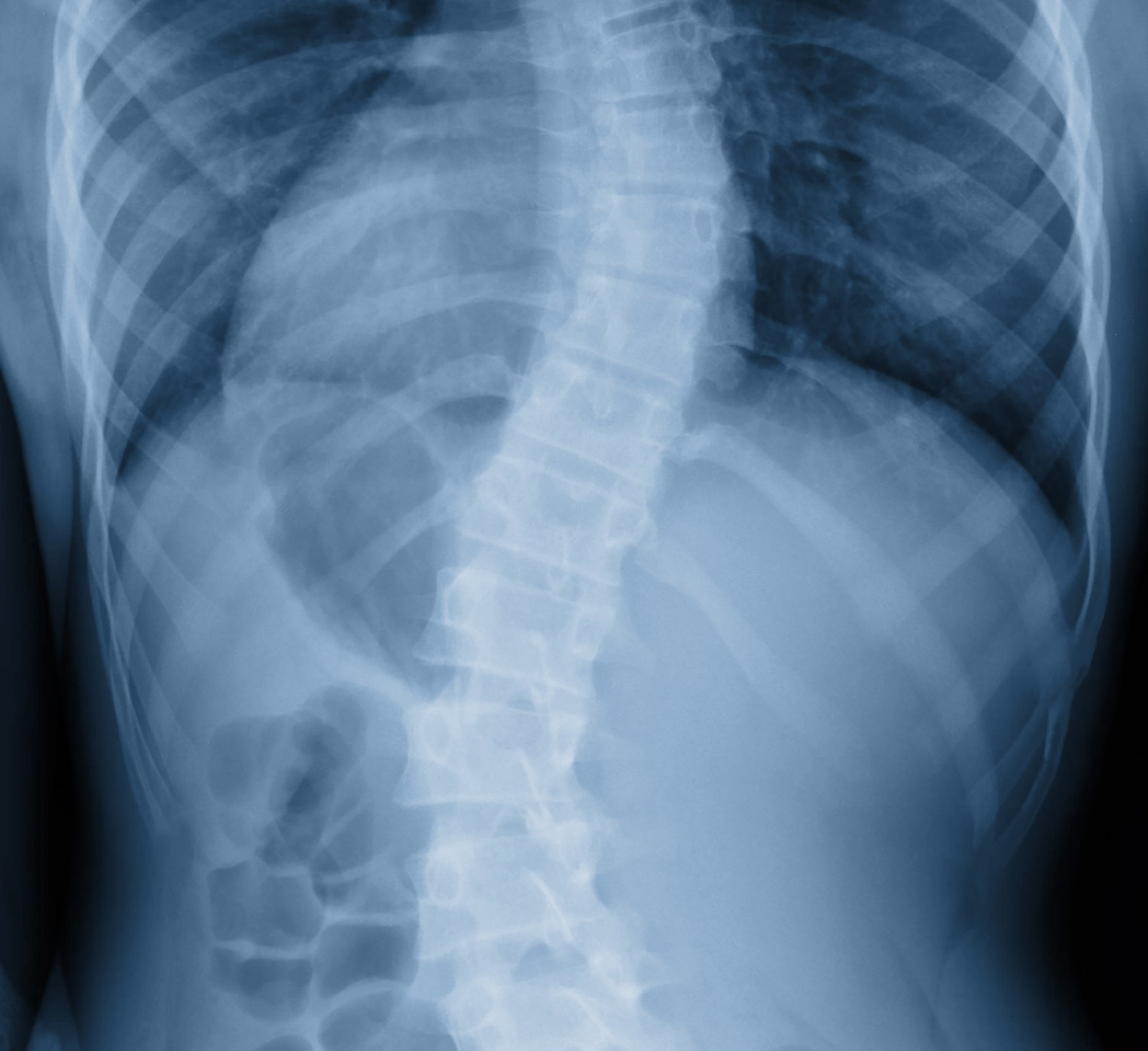 Back X-Ray — Chiropractic Care in Manahawkin, NJ
