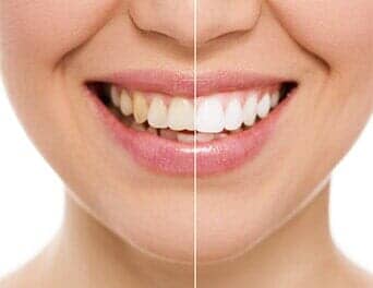 Teeth before and after — Dentist Care in Naples, FL
