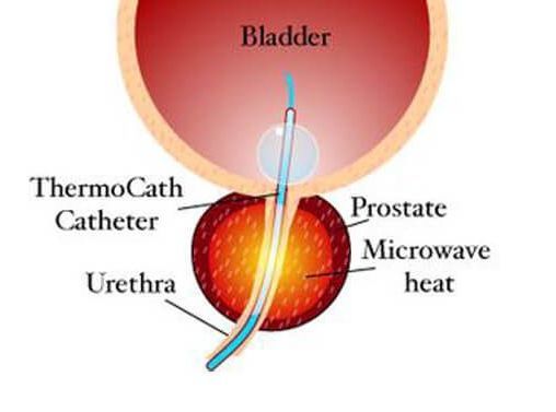 A diagram of a bladder with a thermo cath catheter in it