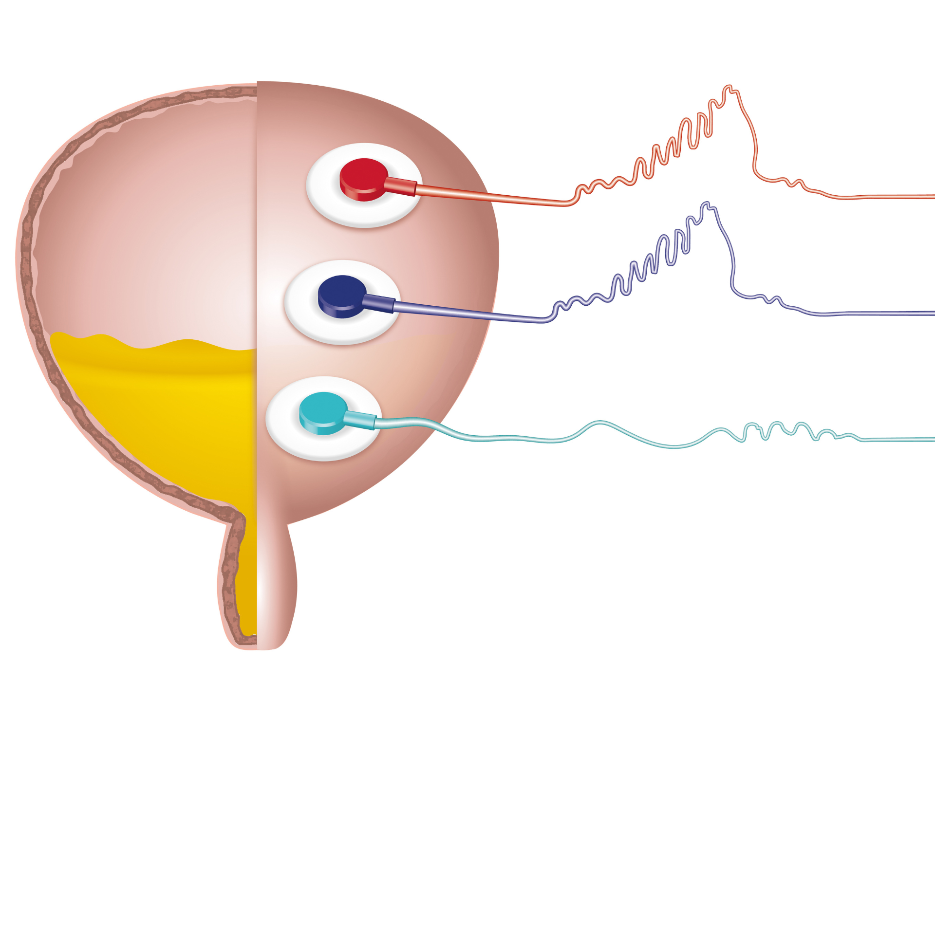 A diagram of a urinary bladder with three wires coming out of it