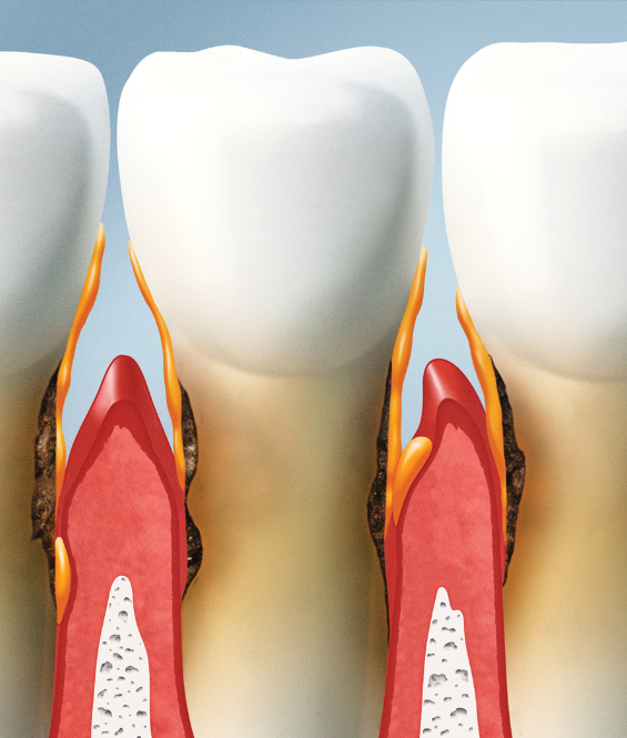 Teeth with gum disease | therapy in Coraopolis PA