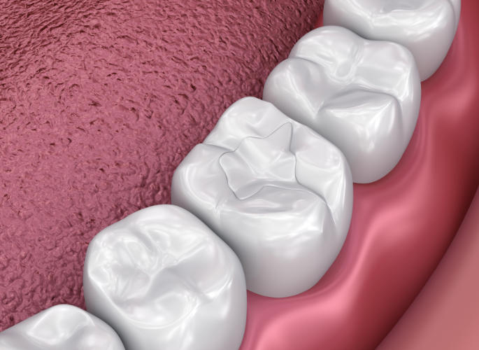 Dental fillings | Same day dentist in Coraopolis PA