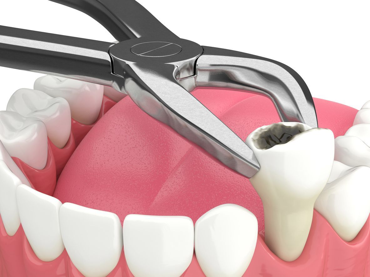 tooth getting extracted | Dentist in Coraopolis PA