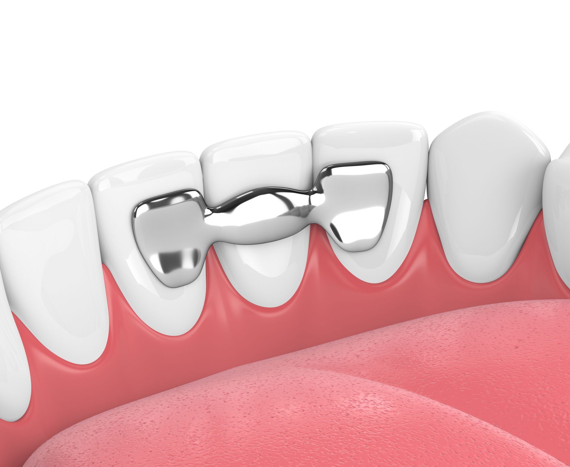 tooth with dental bridge | Restorative dentist in Coraopolis PA