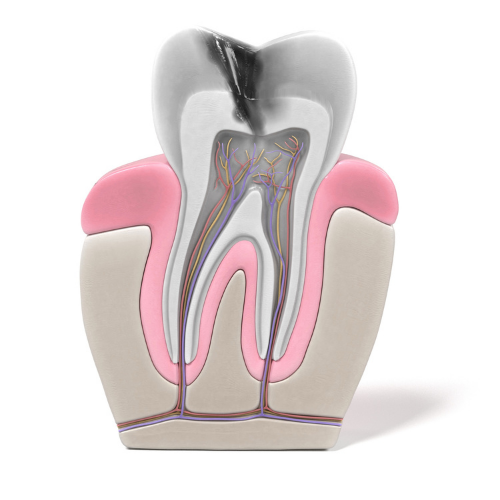 image of tooth showing a need for a root canal | Dentist in Coraopolis PA