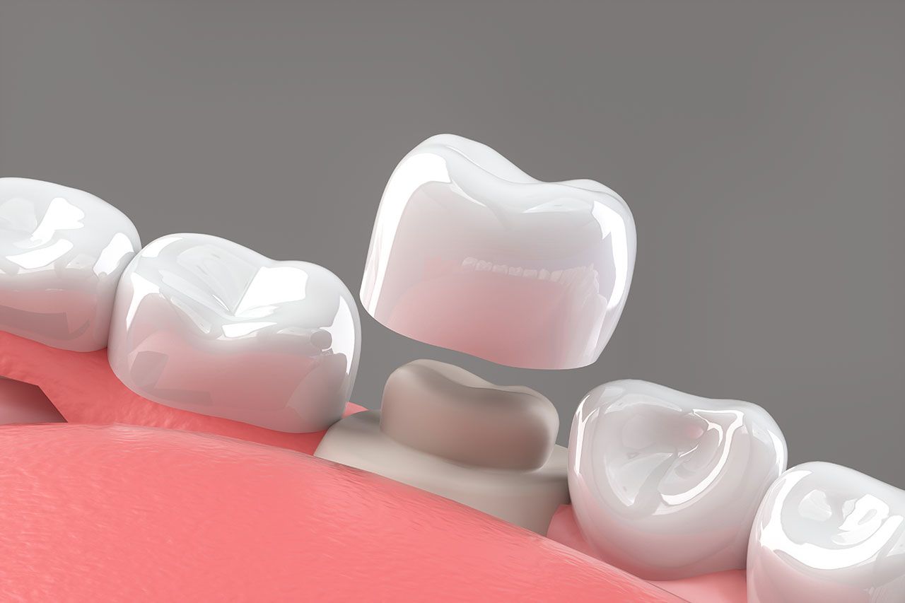 Dental Crown Dentist Near Me