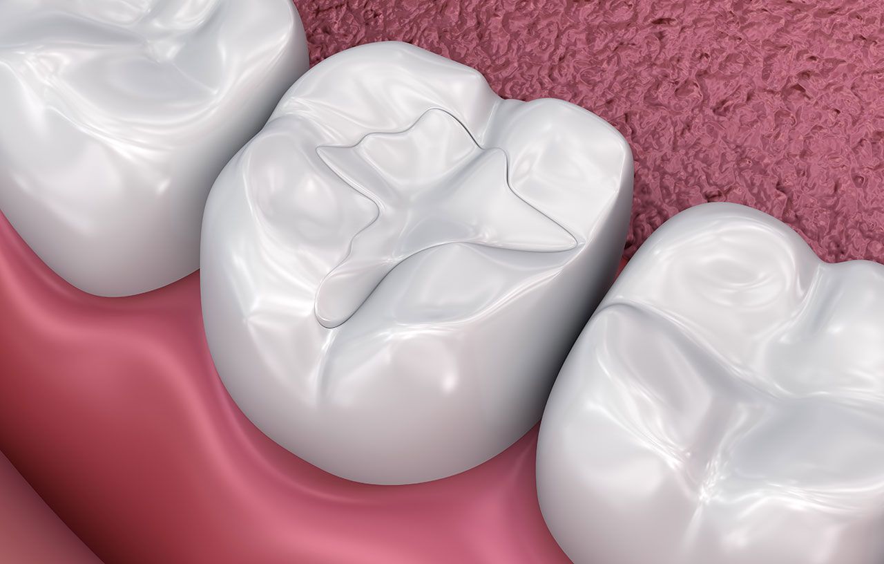 Tooth-Colored Fillings