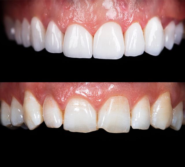 Discolored Tooth Filling  Annapolis Specialist for Restoring Your